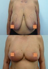 Zmenšení prsou - Body klinika plastické chirurgie