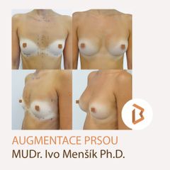 Zvětšení prsou - Body klinika plastické chirurgie