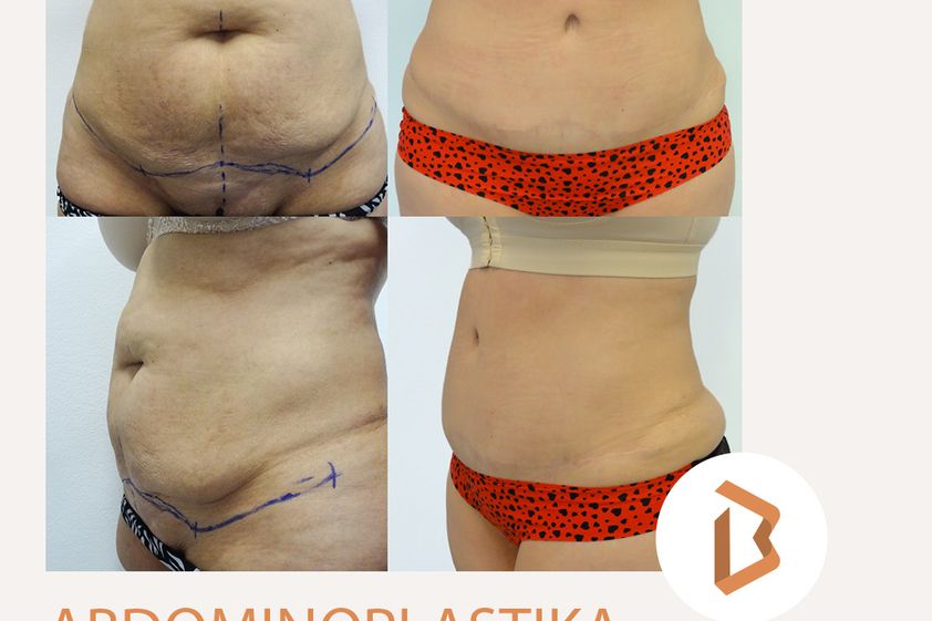 Abdominoplastika před a po - 863463