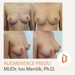 Zvětšení prsou - Body klinika plastické chirurgie