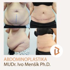 Abdominoplastika - Body klinika plastické chirurgie