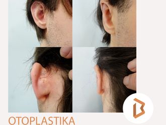 Otoplastika - 865384