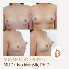 Zvětšení prsou - Body klinika plastické chirurgie