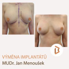 Zvětšení prsou - Body klinika plastické chirurgie