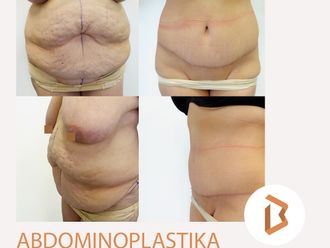 Abdominoplastika před a po - 869838