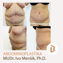 Abdominoplastika - Body klinika plastické chirurgie