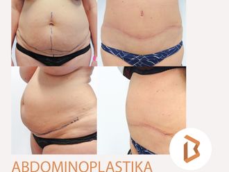 Abdominoplastika před a po - 870259