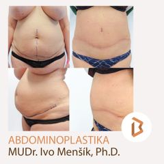 Abdominoplastika - Body klinika plastické chirurgie