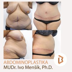 Abdomino Bedakovic Zuzana