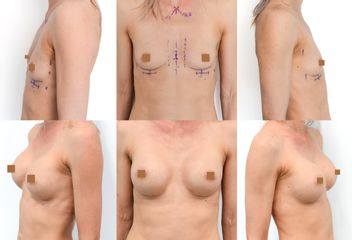 Body klinika plastické chirurgie - Augmentace prsou kulatými implantáty