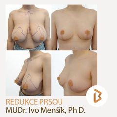 Redukce Prsou Body klinika plastické chirurgie