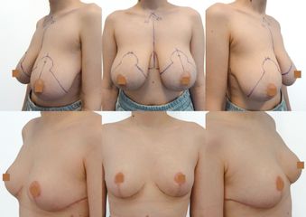 Redukce Prsou Body klinika plastické chirurgie