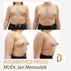augmentace tuberózních prsou