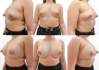 augmentace tuberózních prsou