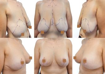 Body klinika plastické chirurgie - Modelace Prsou