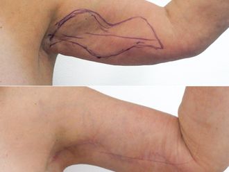 Plastická operace paží před a po - 877989