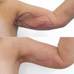 Body klinika plastické chirurgie Predapo-lifting