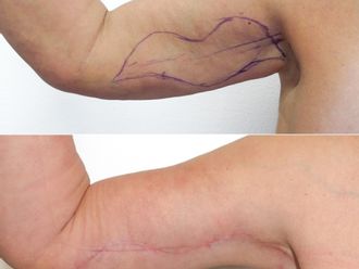 Plastická operace paží před a po - 877990