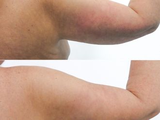 Plastická operace paží před a po - 877991