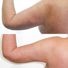 Body klinika plastické chirurgie Predapo-lifting