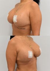 Body klinika plastické chirurgie - Výměna prsních implantátů