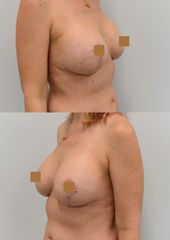 Augmentace s modelací prsou bilat., implantáty 325 cc, operatér MUDr. Menoušek.