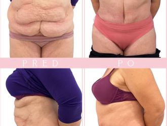 Abdominoplastika před a po - 878525