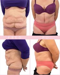 Body klinika plastické chirurgie Abdominoplastika
