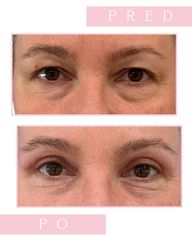 MUDr. Kamila Podkalská Sommerová  Horní víčka