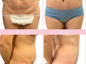Abdominoplastika před a po - 878924