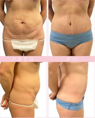 Body klinika plastické chirurgie - Abdominoplastika a její výsledek