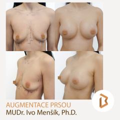 MUDr. Menšík - Augmentace prsou