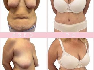 Abdominoplastika před a po - 879967