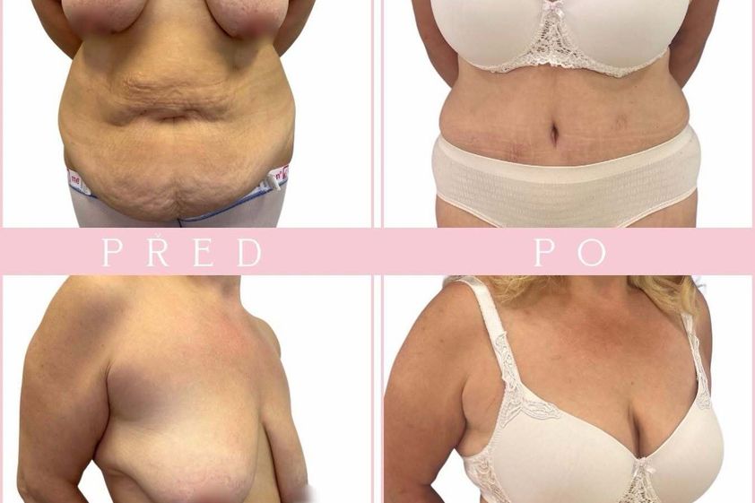 Abdominoplastika před a po - 879967
