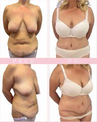Kompletní abdominoplastika