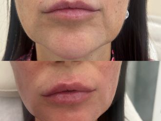 Antiaging před a po - 856703