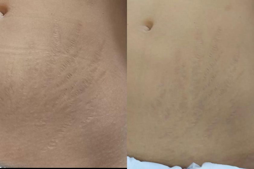 Microneedling před a po - 731092