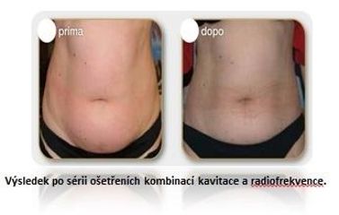 Břicho - kavitace + radiofrekvence