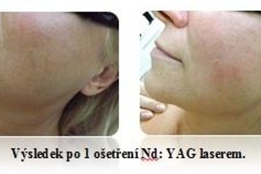 Laserová léčba akné před a po - 731096