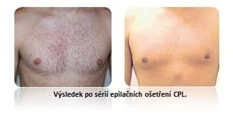 Muž - epilace CPL metodou