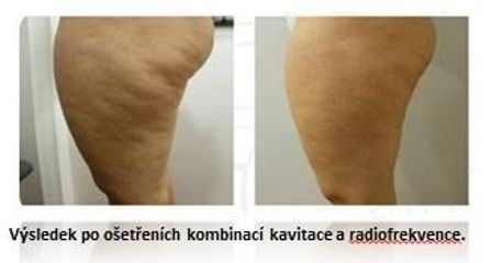 Celulitida - kavitace + radiofrekvence