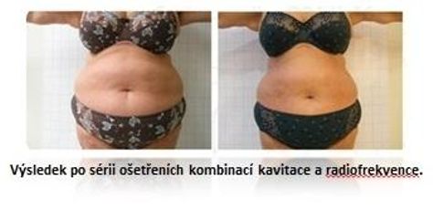 Žena - zeštíhlení kavitace a radiofrekvence