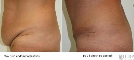 BEFORE abdominoplastika4