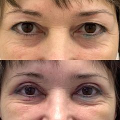 Operace očních víček (Blefaroplastika)