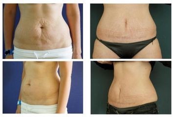 Abdominoplastika 2
