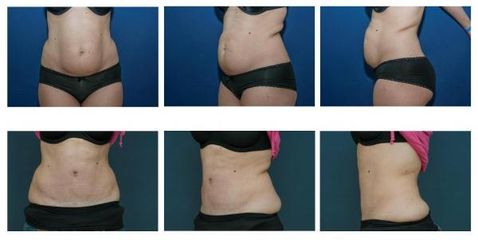 Abdominoplastika 3