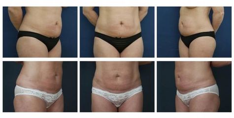 Liposukce1