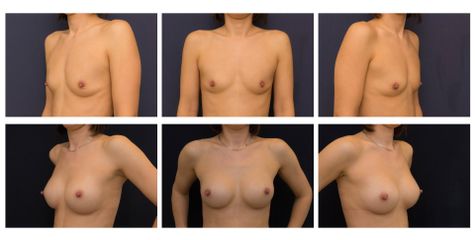 Breast augmentation