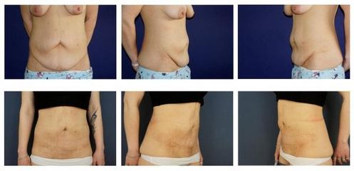 Abdominoplastika 4