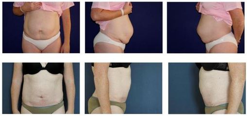 Abdominoplastika 5